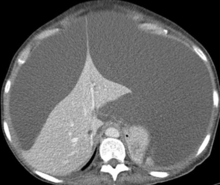 肝包膜皱缩，除了胆管细胞癌，还有这几种情况-11