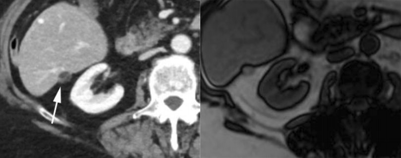 肝包膜皱缩，除了胆管细胞癌，还有这几种情况-12