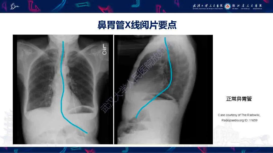 【PPT】胃肠营养管影像评估-7