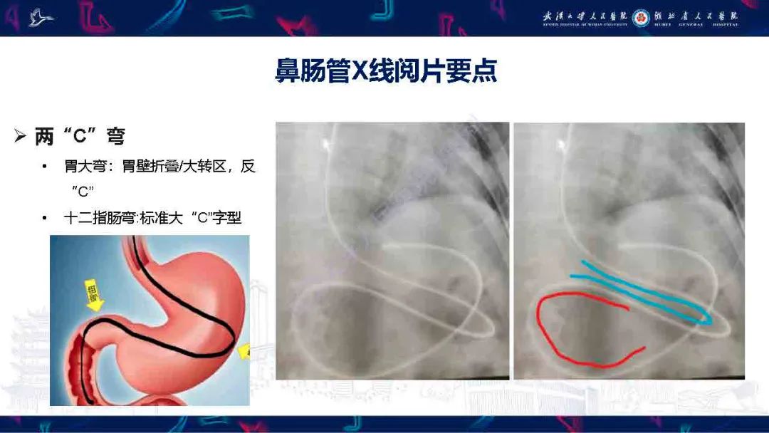 【PPT】胃肠营养管影像评估-9