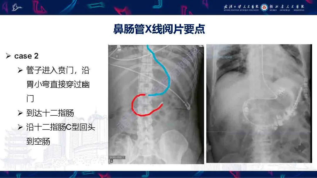 【PPT】胃肠营养管影像评估-10