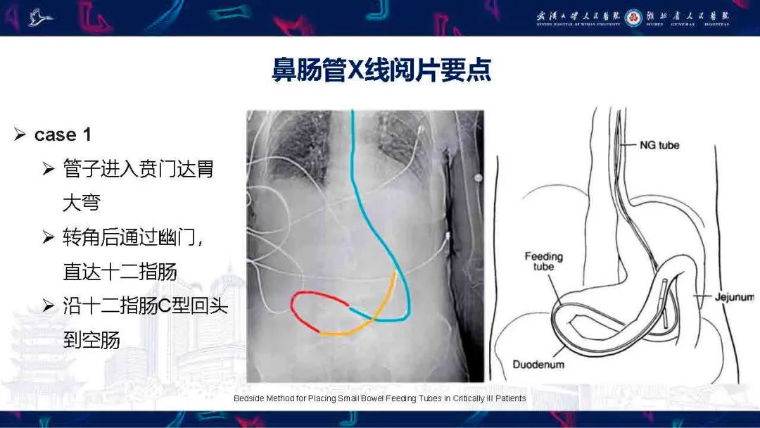 【PPT】胃肠营养管影像评估-8