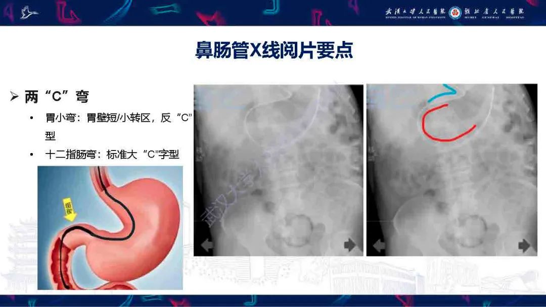 【PPT】胃肠营养管影像评估-11