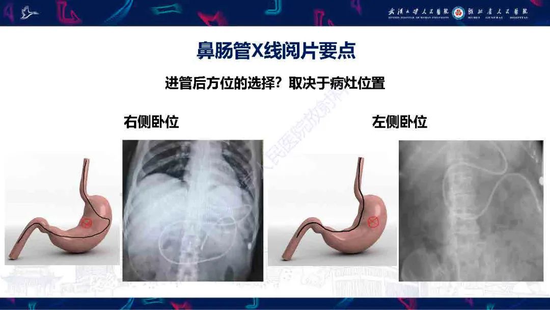 【PPT】胃肠营养管影像评估-12