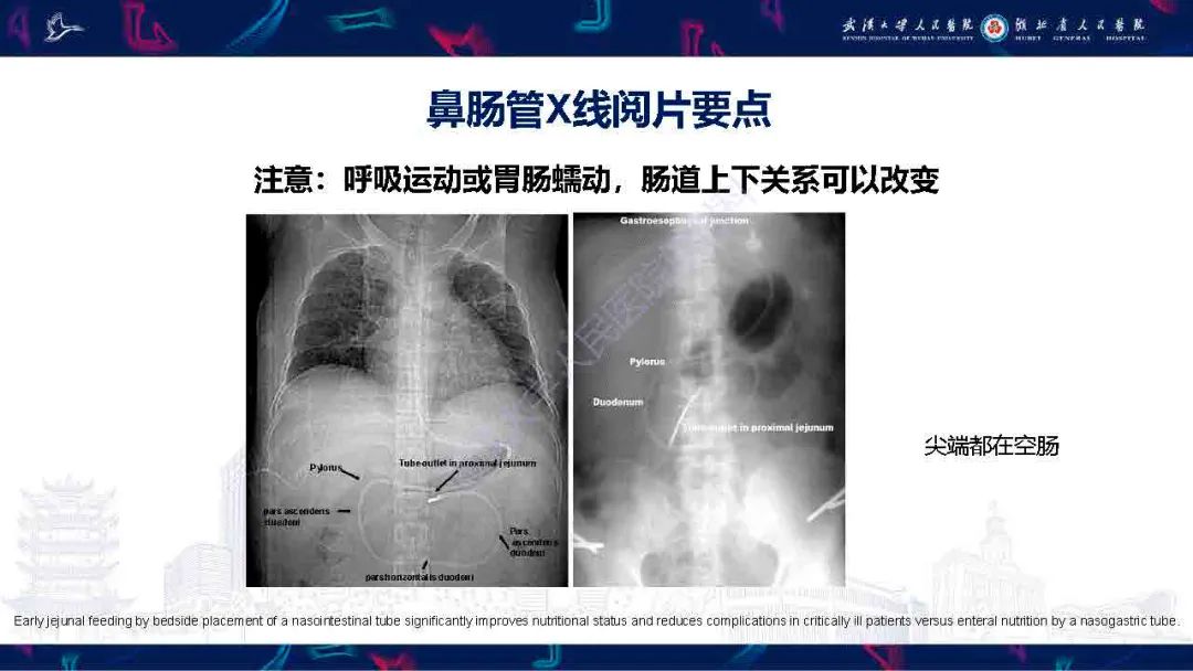 【PPT】胃肠营养管影像评估-13