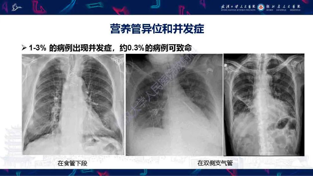 【PPT】胃肠营养管影像评估-17