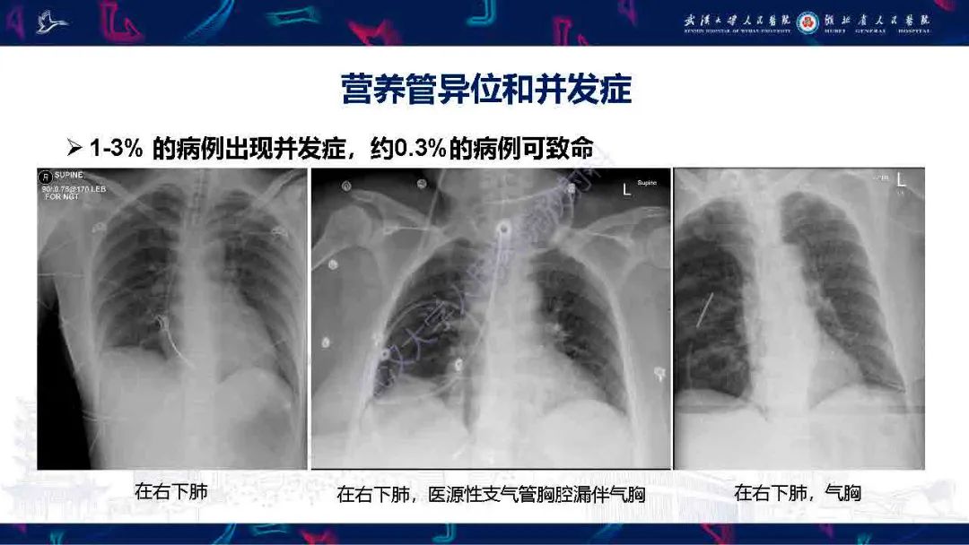 【PPT】胃肠营养管影像评估-18