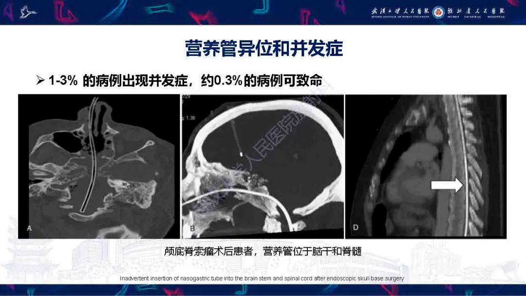 【PPT】胃肠营养管影像评估-20