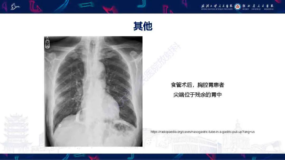 【PPT】胃肠营养管影像评估-22