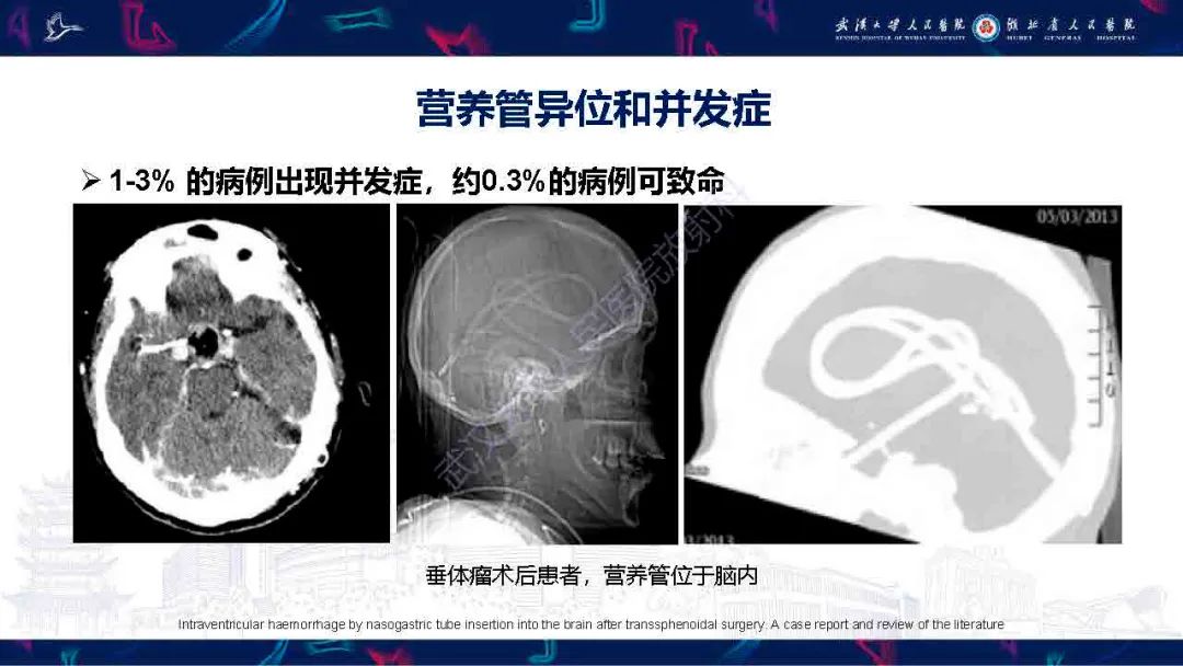 【PPT】胃肠营养管影像评估-21