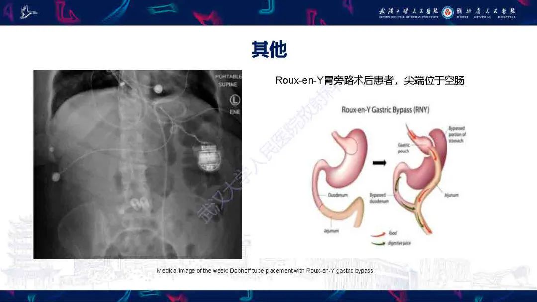 【PPT】胃肠营养管影像评估-23