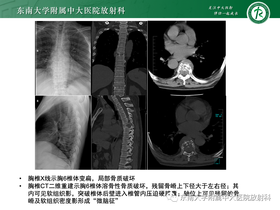 【PPT】骨孤立性浆细胞瘤-4
