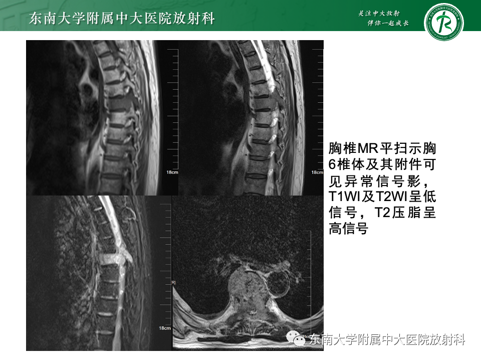 【PPT】骨孤立性浆细胞瘤-5