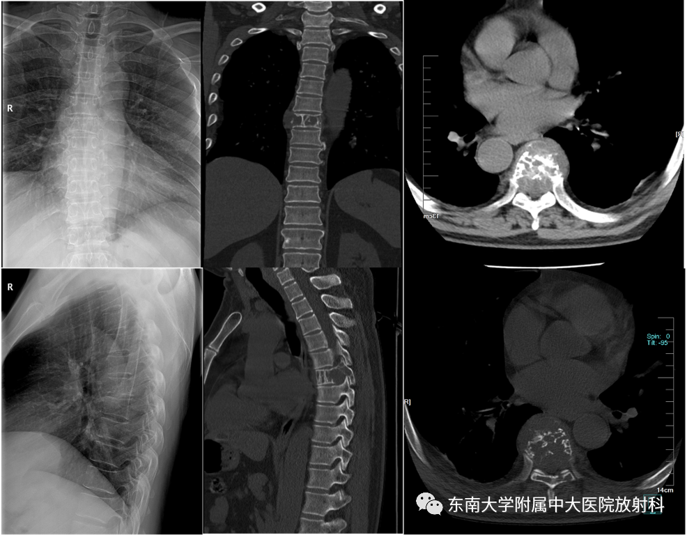 【PPT】骨孤立性浆细胞瘤-1