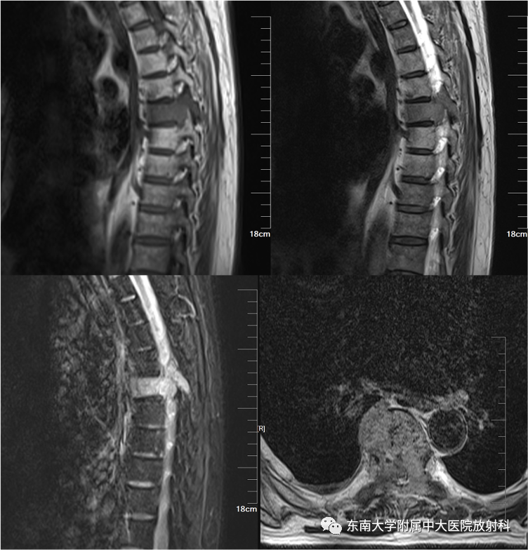 【PPT】骨孤立性浆细胞瘤-2