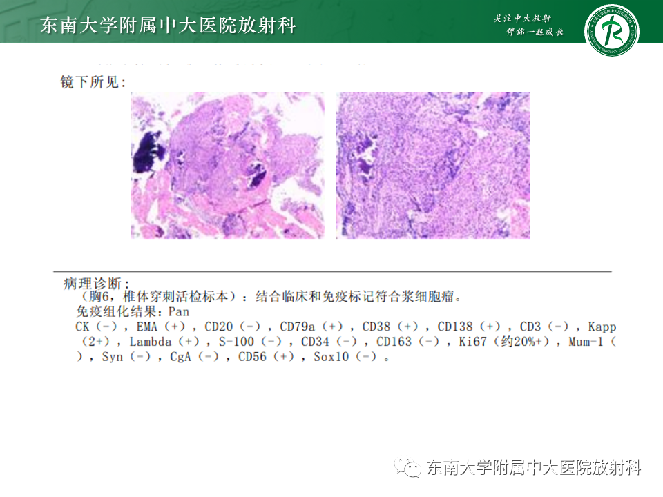 【PPT】骨孤立性浆细胞瘤-6