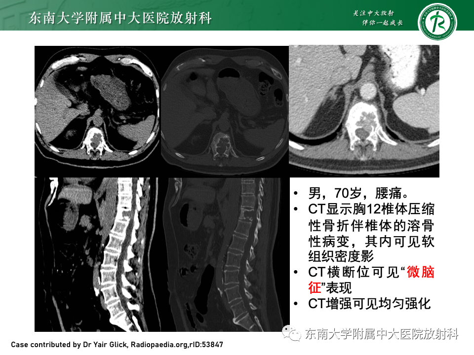 【PPT】骨孤立性浆细胞瘤-14
