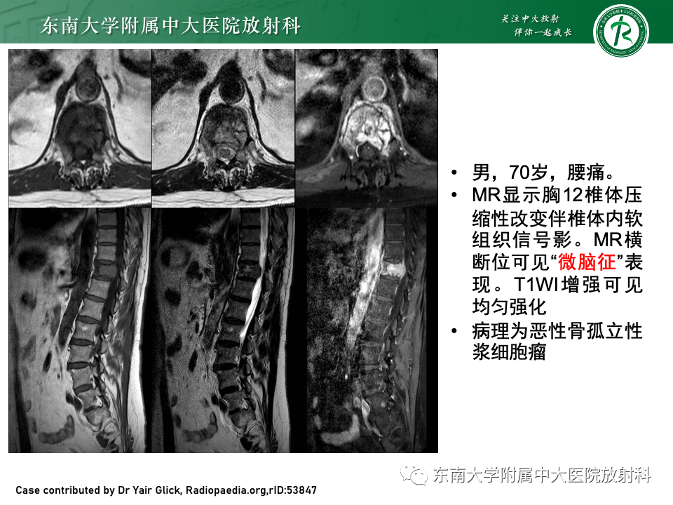 【PPT】骨孤立性浆细胞瘤-15