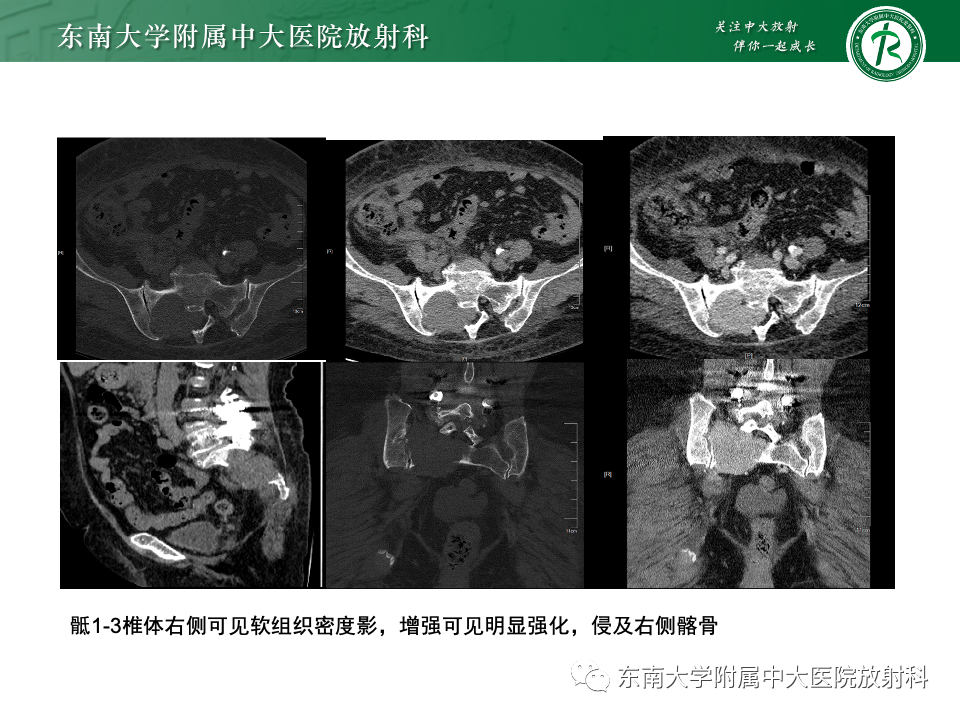 【PPT】骨孤立性浆细胞瘤-17