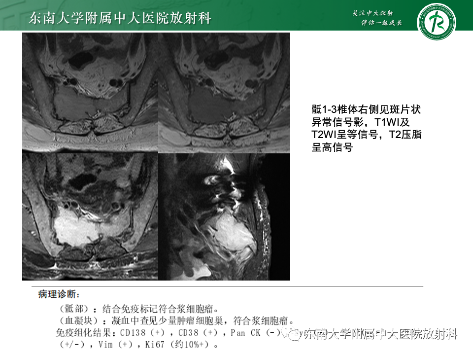 【PPT】骨孤立性浆细胞瘤-18