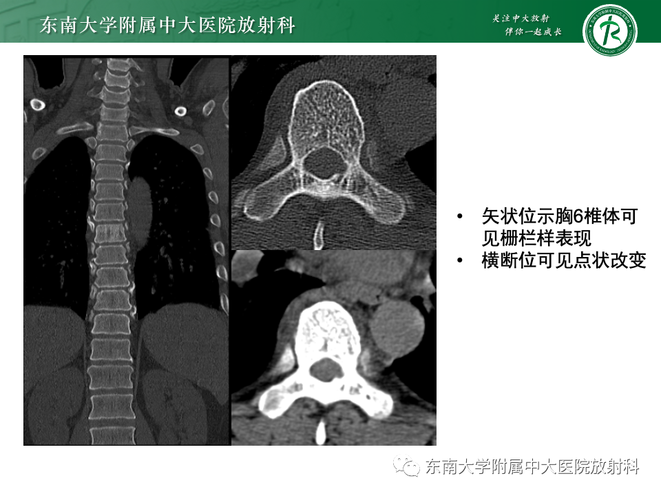 【PPT】骨孤立性浆细胞瘤-22