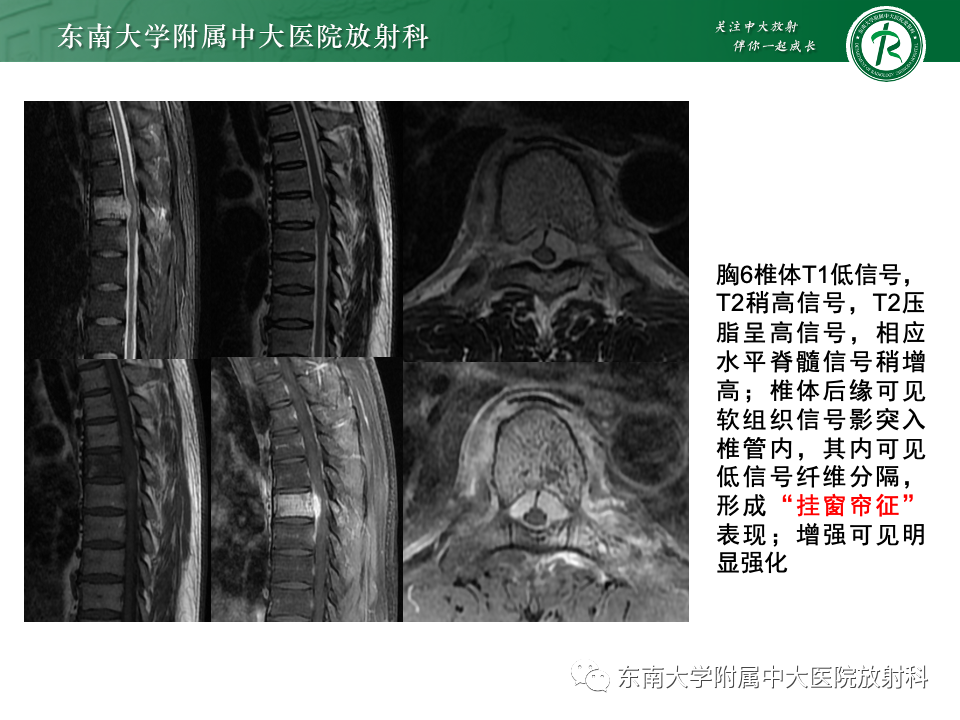 【PPT】骨孤立性浆细胞瘤-23