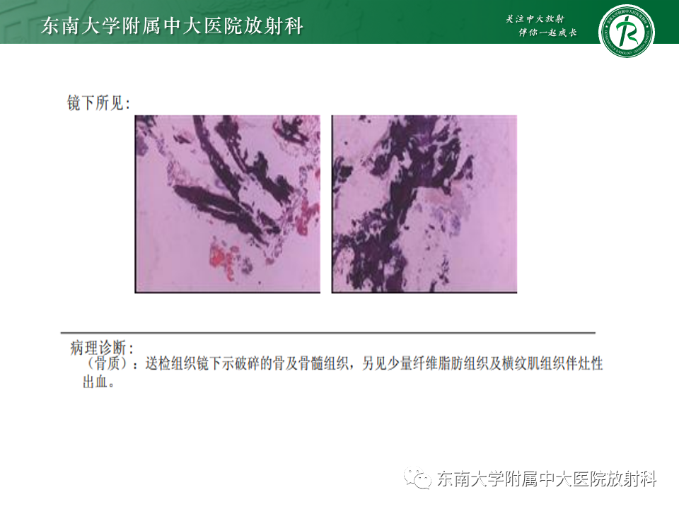 【PPT】骨孤立性浆细胞瘤-24