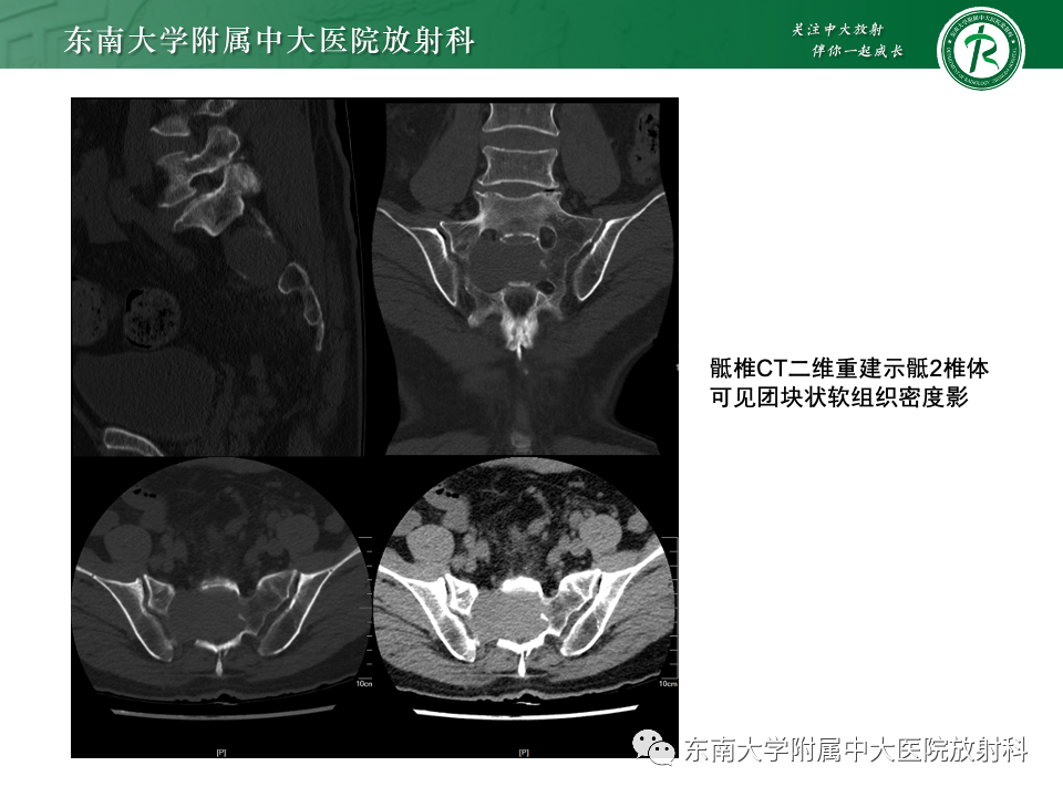【PPT】骨孤立性浆细胞瘤-27