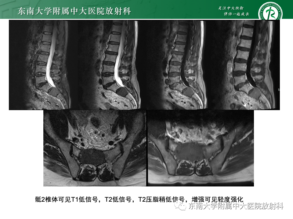 【PPT】骨孤立性浆细胞瘤-28