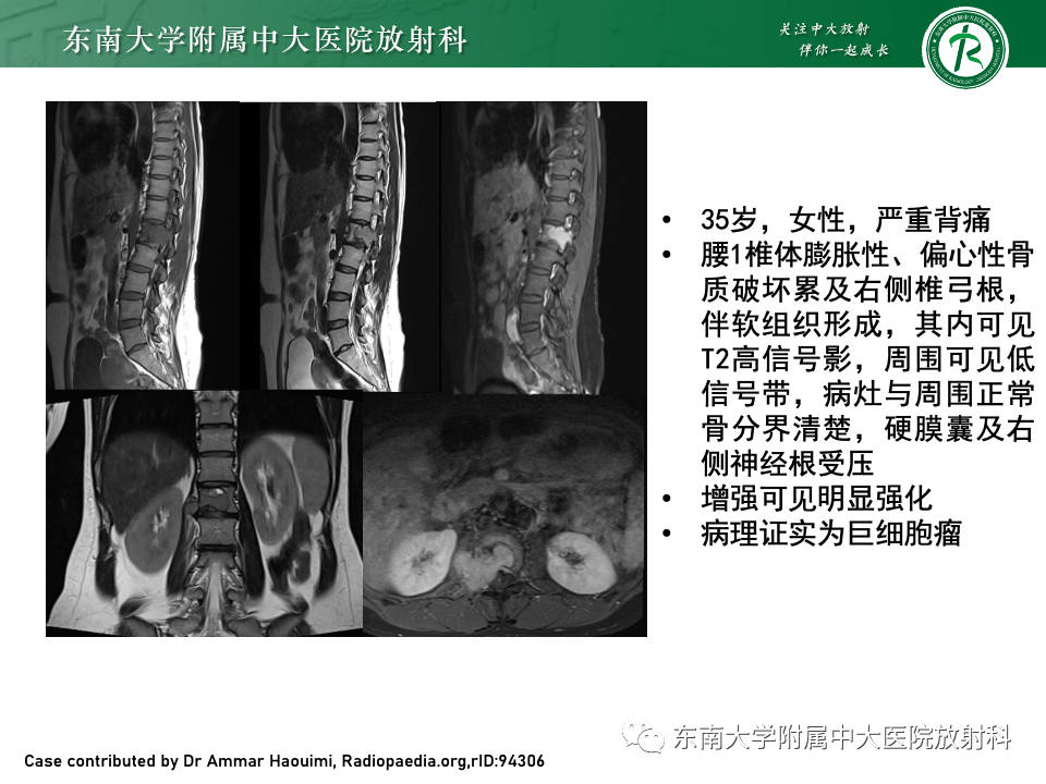 【PPT】骨孤立性浆细胞瘤-31