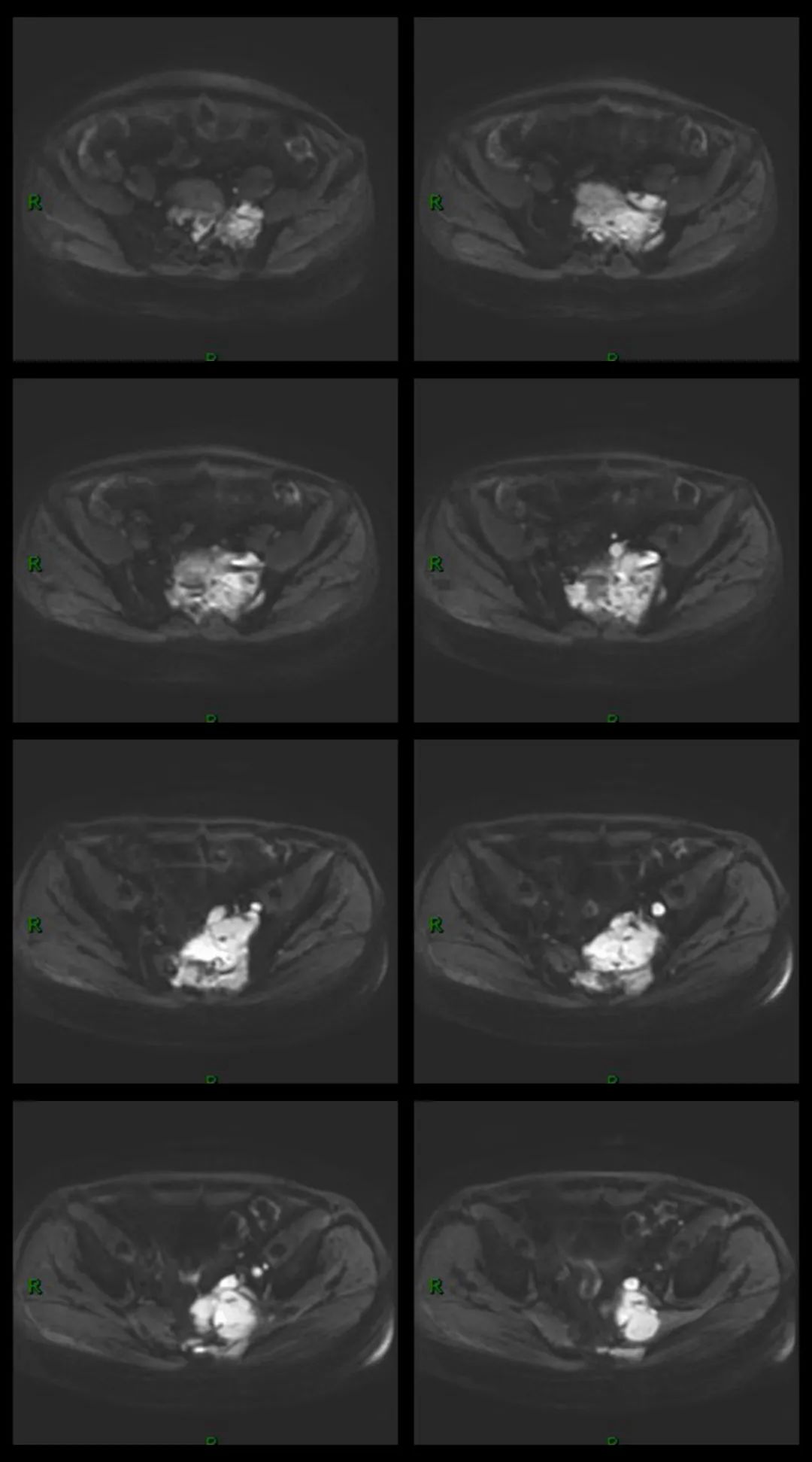 【病例】骶骨淋巴瘤1例CT及MR影像-2
