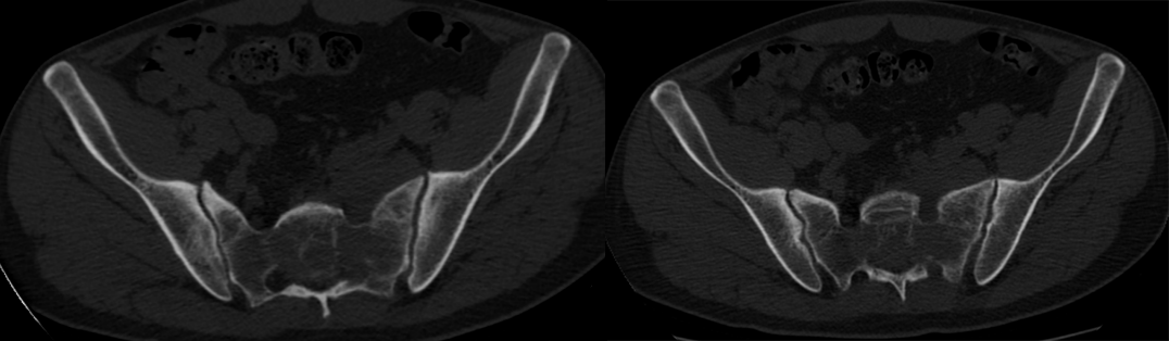 【病例】骶骨淋巴瘤1例CT及MR影像-1