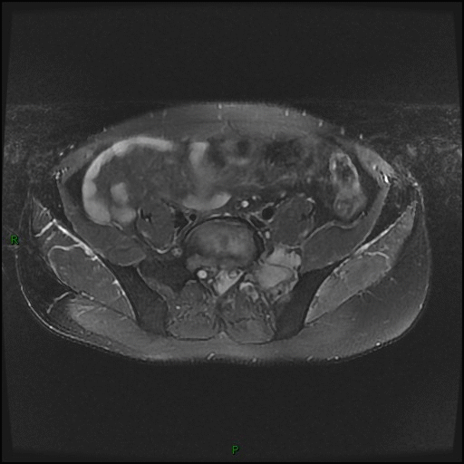 【病例】骶骨淋巴瘤1例CT及MR影像-3