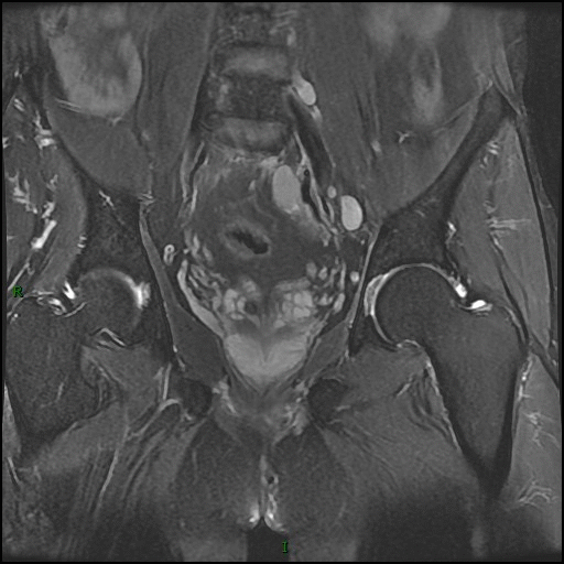 【病例】骶骨淋巴瘤1例CT及MR影像-4