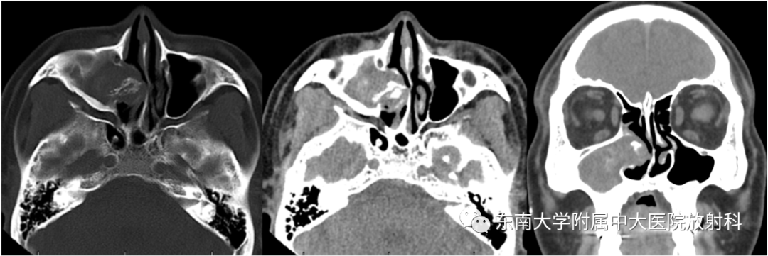 【PPT】真菌性鼻窦炎-1