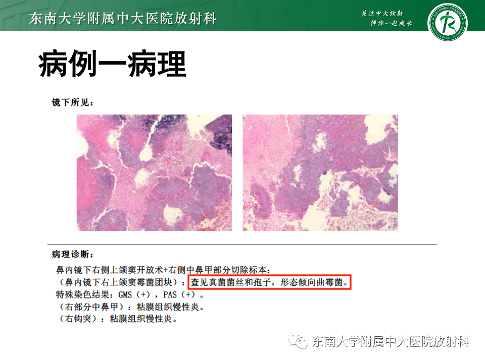 【PPT】真菌性鼻窦炎-3