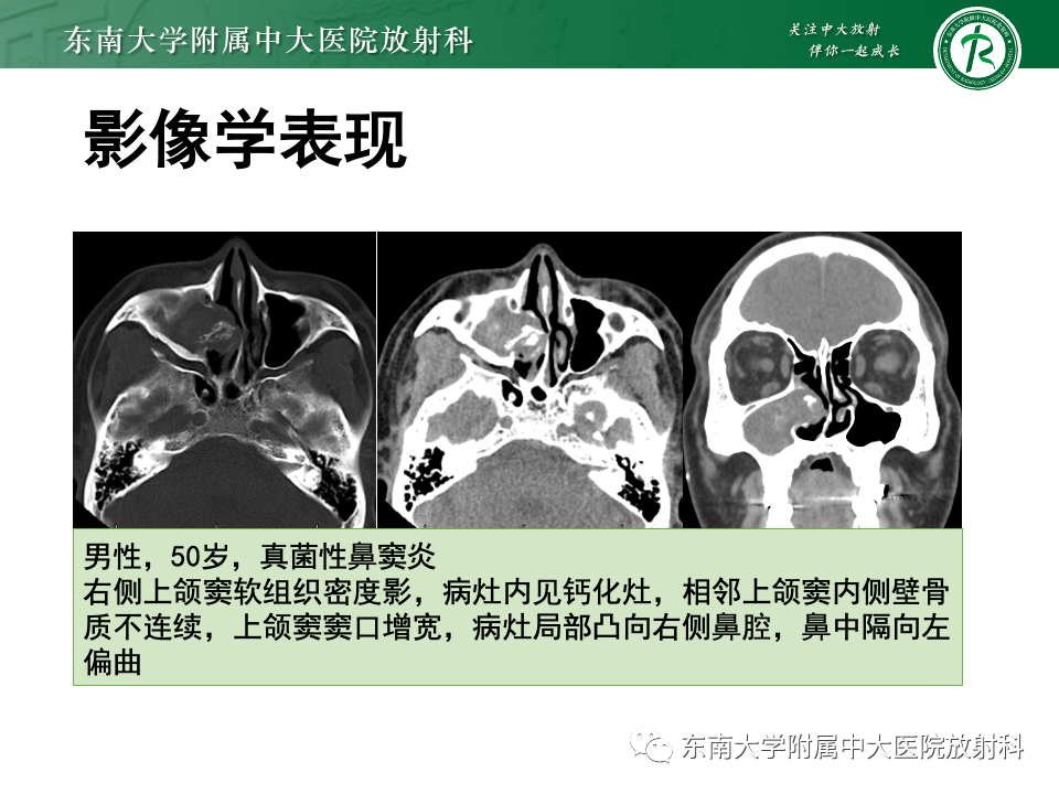 【PPT】真菌性鼻窦炎-2