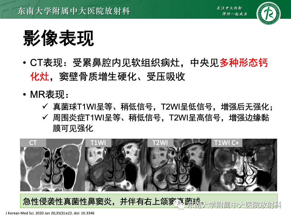 【PPT】真菌性鼻窦炎-10