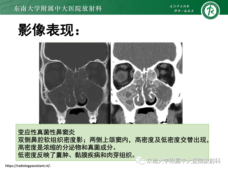【PPT】真菌性鼻窦炎-13