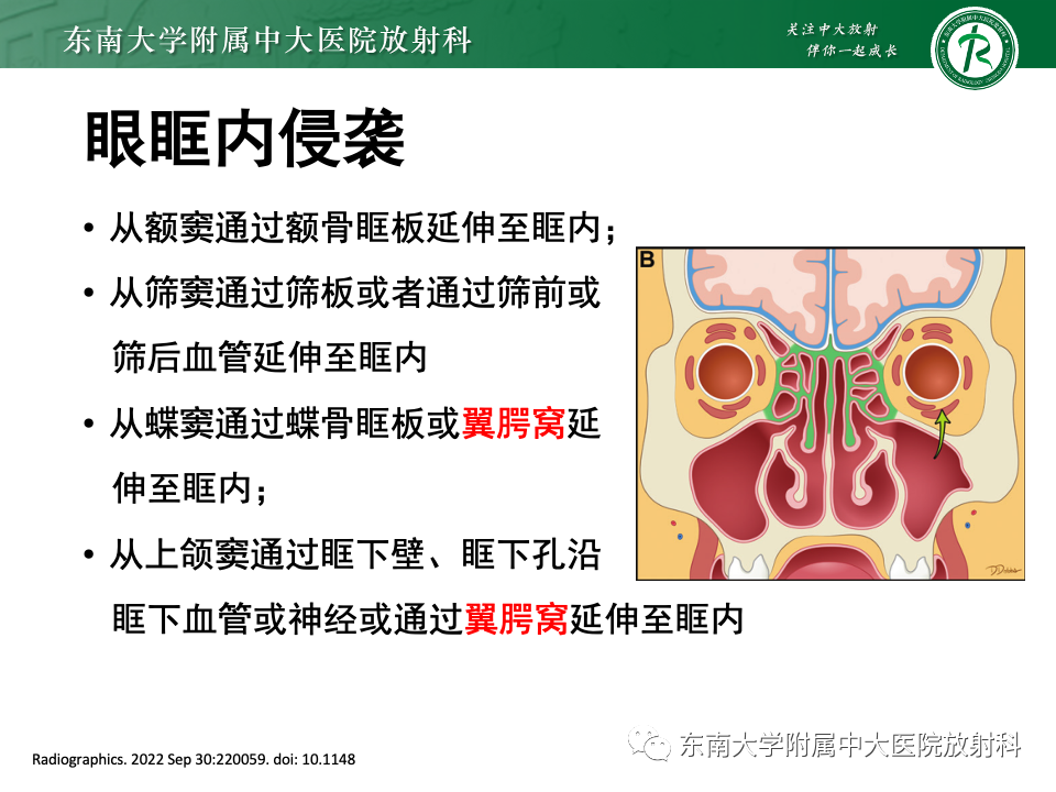 【PPT】真菌性鼻窦炎-16