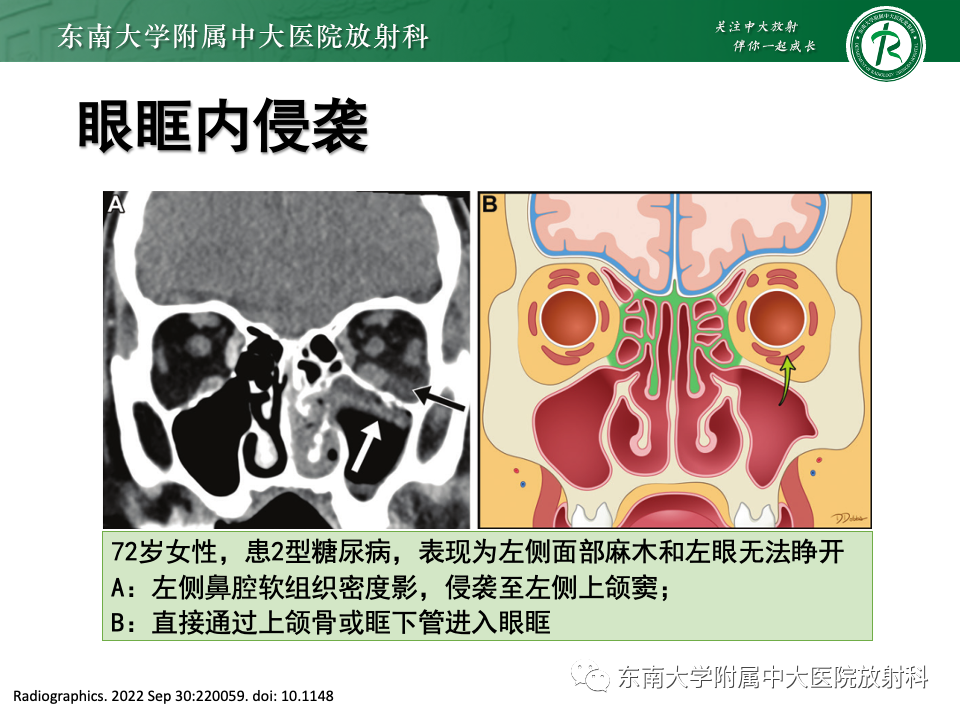 【PPT】真菌性鼻窦炎-17