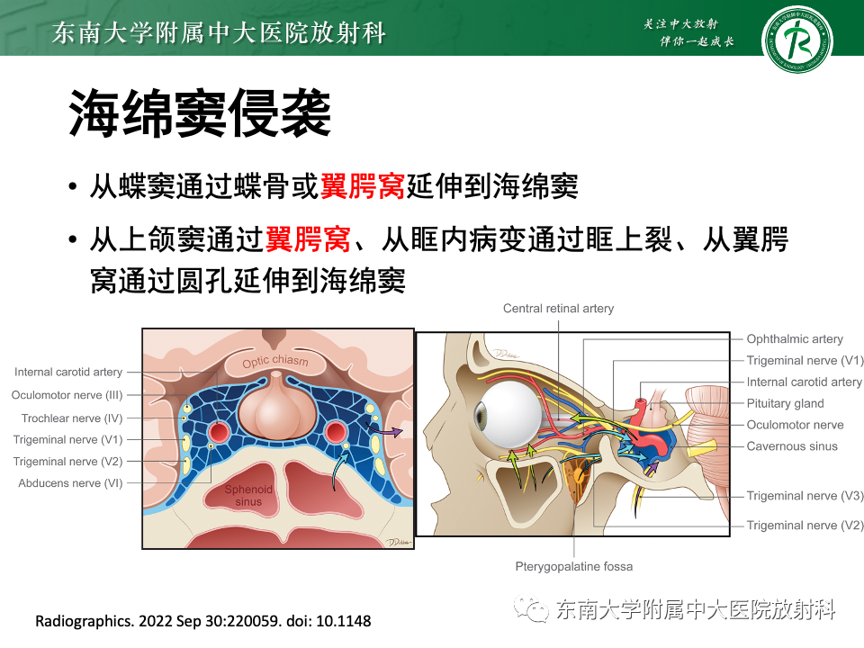 【PPT】真菌性鼻窦炎-18