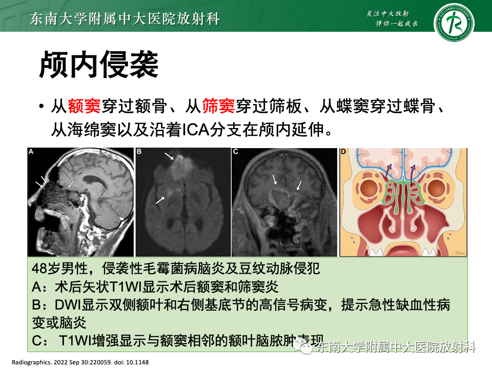 【PPT】真菌性鼻窦炎-19