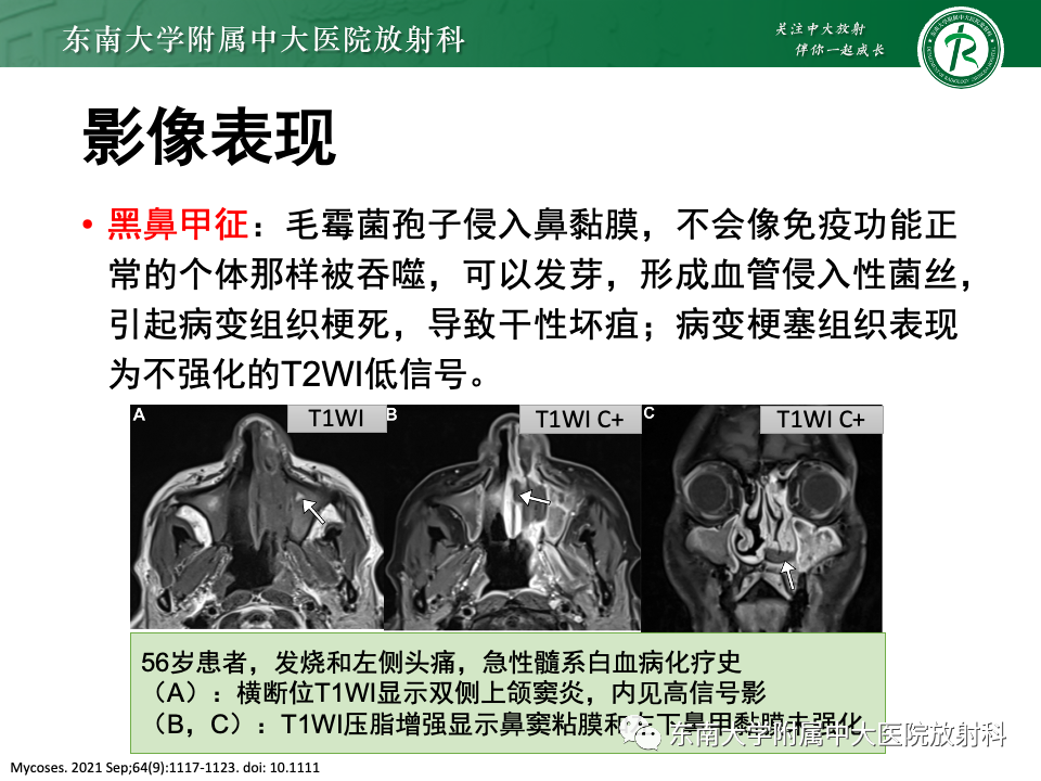 【PPT】真菌性鼻窦炎-24