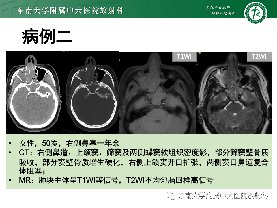 【PPT】真菌性鼻窦炎-27
