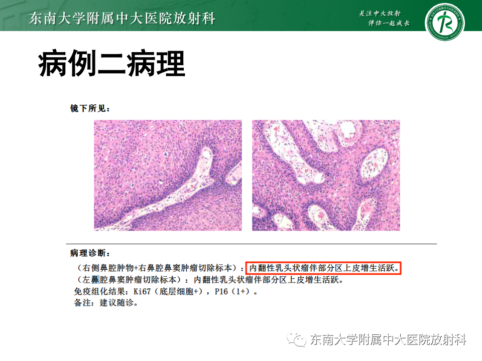 【PPT】真菌性鼻窦炎-28
