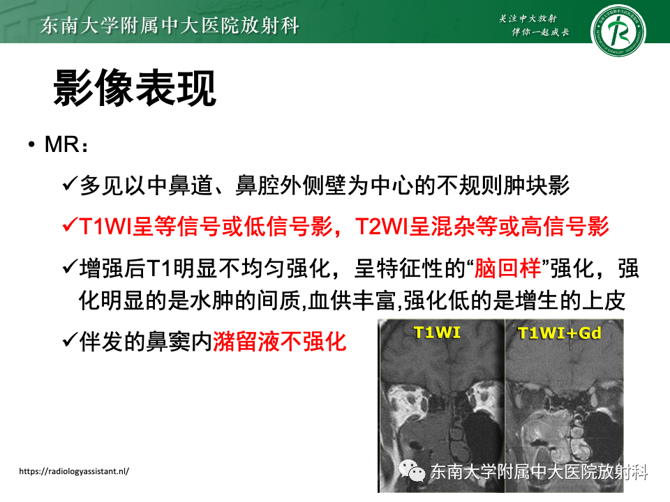 【PPT】真菌性鼻窦炎-32