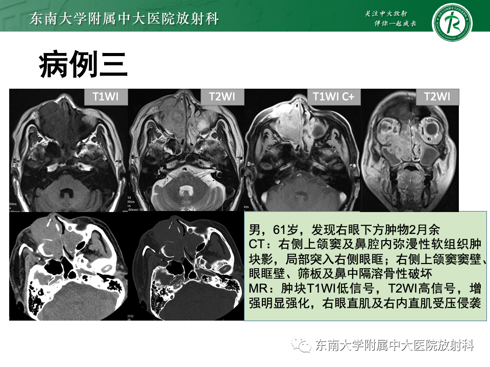【PPT】真菌性鼻窦炎-33