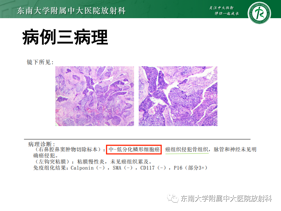 【PPT】真菌性鼻窦炎-34