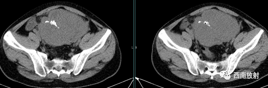胃肠道间质瘤-2